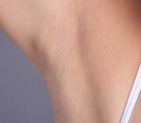 Sugaring Hair Removal in Bournemouth Image 2